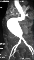 腹部大動脈瘤の術前CT画像